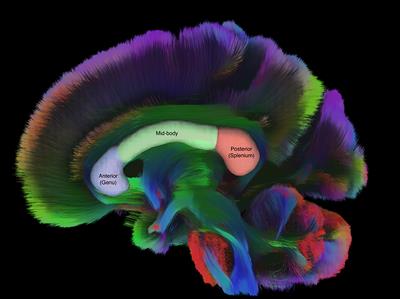 Diffusion in the corpus callosum predicts persistence of clinical symptoms after mild traumatic brain injury, a multi-scanner study